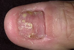 Psoriatic onychodystrophy of the fingernail
