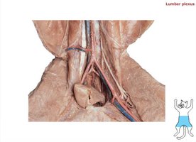 Lumbar plexus dissection