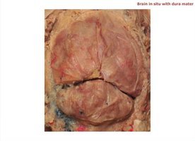 Brain in situ with dura mater