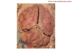 Brain in situ without dura mater, showing surface anatomy