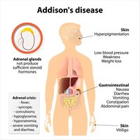 Symptoms and effects of Addison's disease