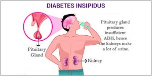 Diagram of diabetes insipidus mechanism