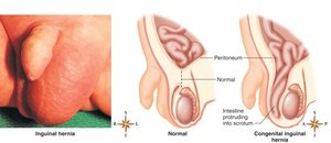 Diagram and photo of congenital inguinal hernia