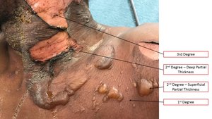 Clinical photograph showing burn classification: 1st, 2nd (superficial and deep partial thickness), and 3rd degree burns