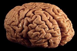 Human brain affected by prion disease