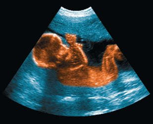 Bone densitometry scan showing osteoporosis