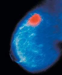 PET scan of the brain showing a tumor