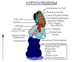 Symptoms and clinical features of hypothyroidism