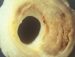 Photograph of an artery with atherosclerotic plaque