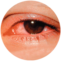 Conjunctivitis (pinkeye)