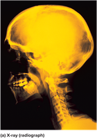 X-ray radiograph of skull