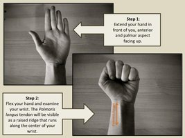 Palmaris longus muscle test