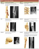 Stages of bone fracture healing