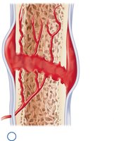 Hematoma formation in bone repair