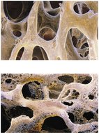 Normal bone vs. osteoporotic bone