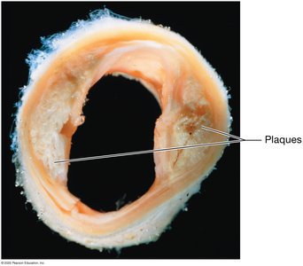 Plaque formation and rupture leading to blood clot