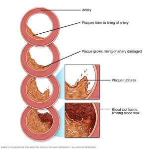 Bypass graft restoring blood flow