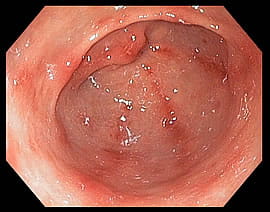 Gastric ulcer endoscopy