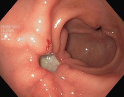 Gastric ulcer endoscopy