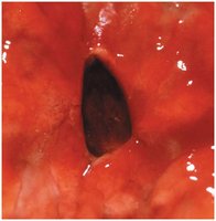 A gastric ulcer
