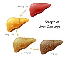Stages of liver damage