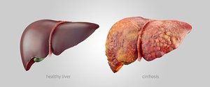 Healthy liver vs cirrhosis