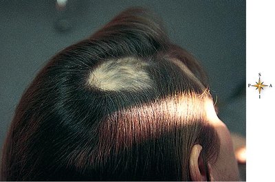 Alopecia areata: patchy hair loss