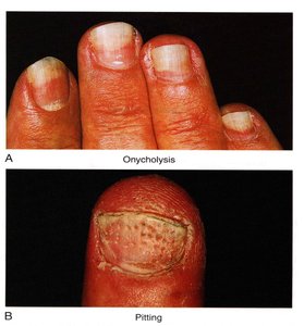 Abnormal variations in nail structure: onycholysis and pitting