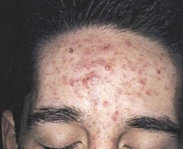 Acne vulgaris: inflammation of sebaceous glands