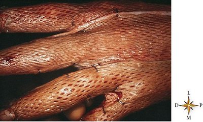 Skin graft for severe skin damage