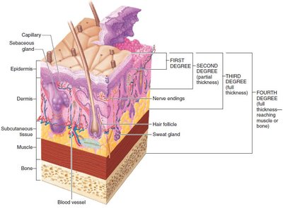 Partial and full-thickness burns
