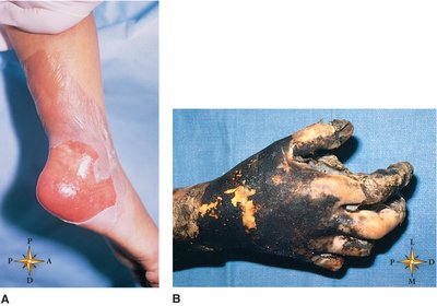 Examples of second and third-degree burns