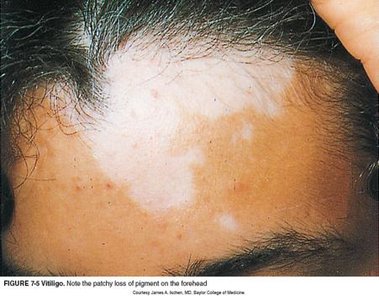 Vitiligo: patchy loss of pigment on the forehead