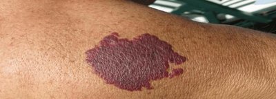Port-wine stain birthmark