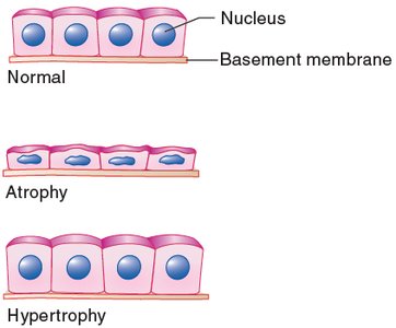 Hyperplasia and anaplasia of cells