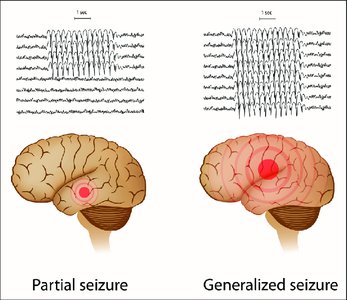 Partial and generalized seizures in the brain