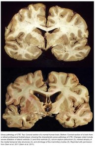 Gross pathology of CTE compared to normal brain
