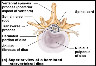Superior view of a herniated intervertebral disc