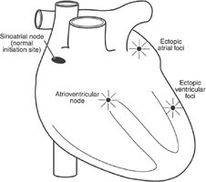 Ectopic pacemaker sites in the heart