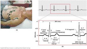 ECG lead placement and intervals