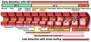Progression of coronary artery disease