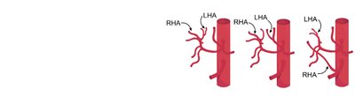 Variation in hepatic artery branching