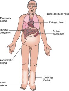 Signs of congestive heart failure: pulmonary and peripheral edema