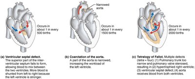 Common congenital heart defects: septal defect, coarctation of the aorta, tetralogy of Fallot