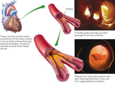 Atherosclerosis and its effects on coronary arteries