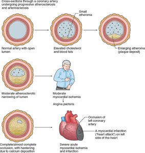 Progression of atherosclerosis and myocardial infarction