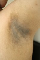 Acanthosis nigricans in the axilla