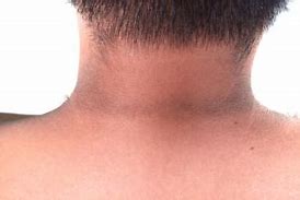 Acanthosis nigricans on the neck