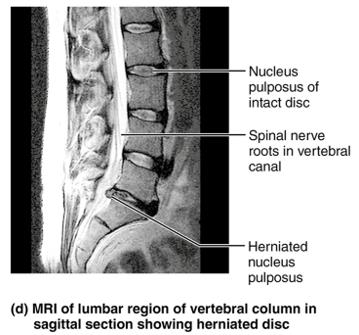 MRI of herniated disc in lumbar region