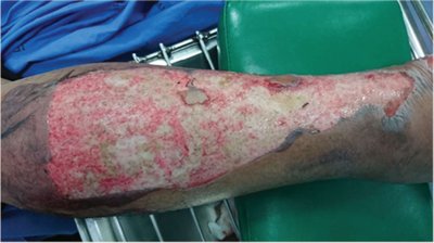 Third-degree burn with exposed tissue